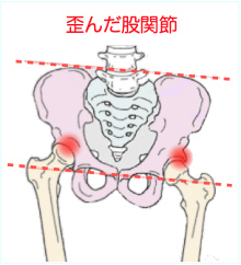 股関節の歪みは骨盤の歪みの元